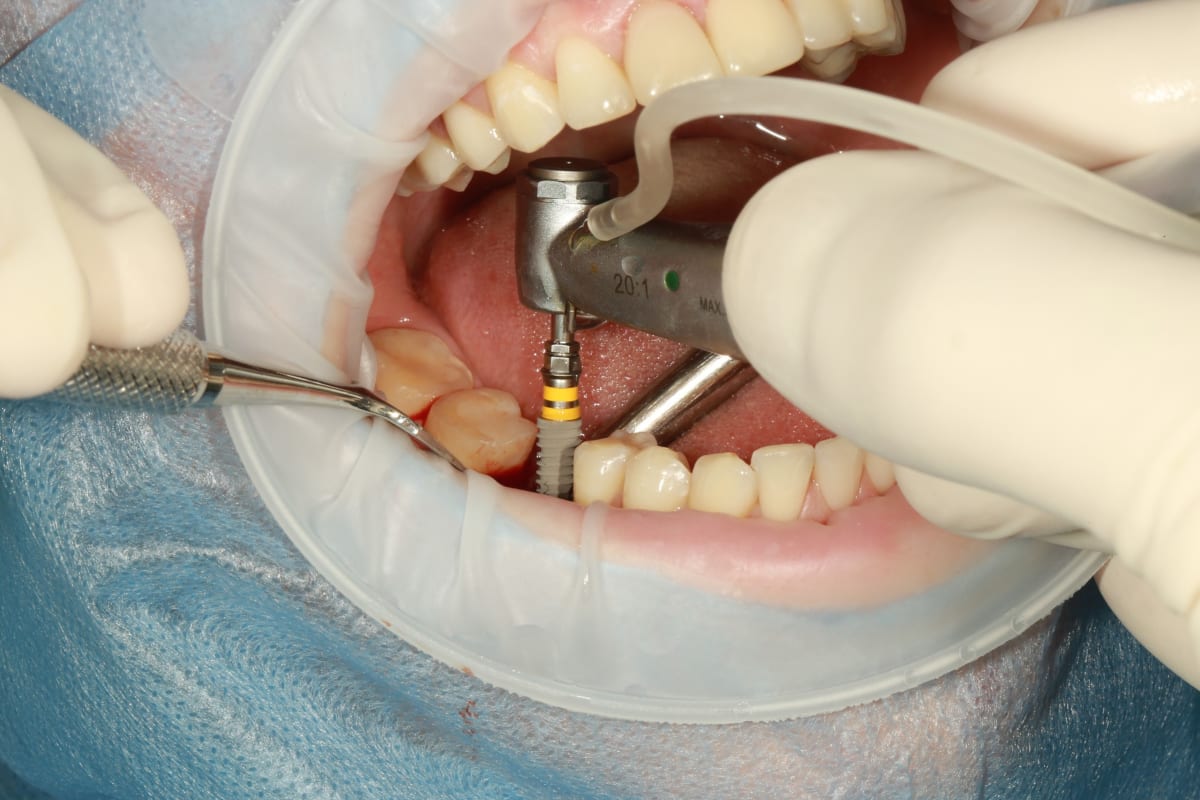 dental implants Poland
