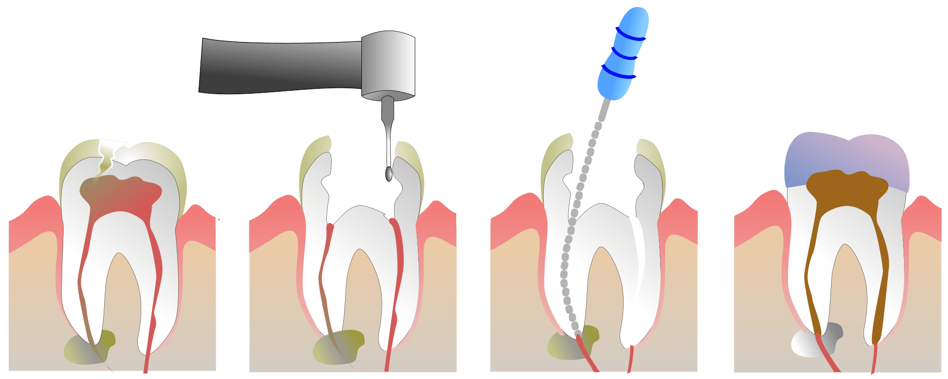 Root canal treatment